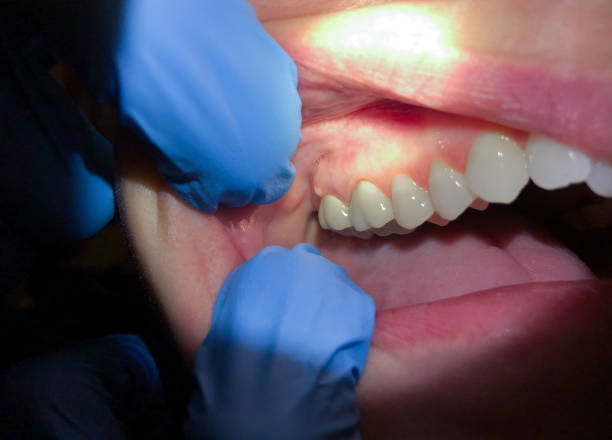 Best Emergency Dental Surgery in East Port Orchard, WA